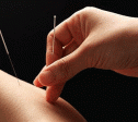 Acupunctuur
